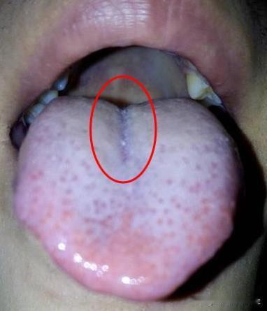 舌暗有瘀、苔白有寒，是瘀血体质？送您1个中成药，活血不留瘀！
这位粉丝生活中几乎