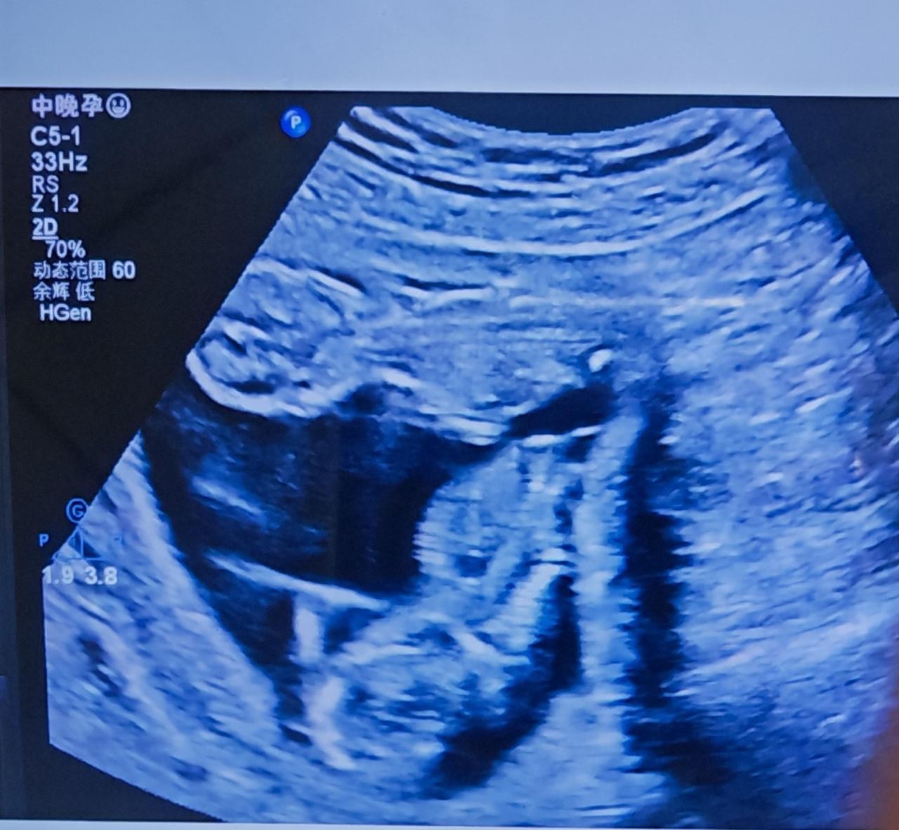 还是忍不住想跟大家分享这个好消息——有位孕妈本来是来做NT建卡的，早期做的超声提
