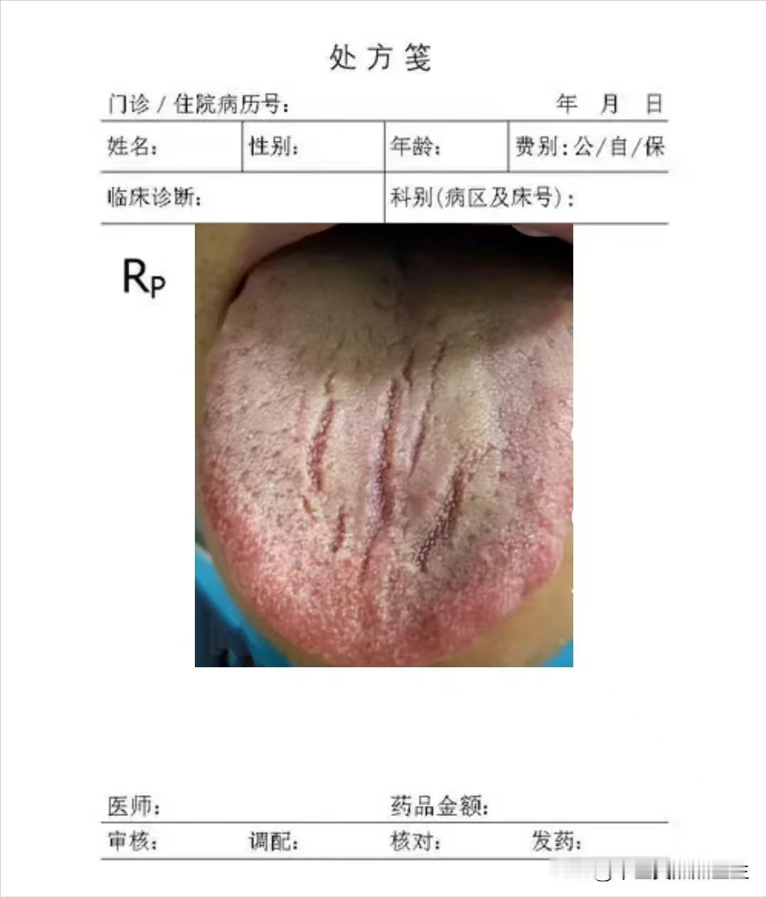 出现这种舌象，不要上来就健脾，不然竹篮打水一场空

患者主诉：平时乏力没精神，吃
