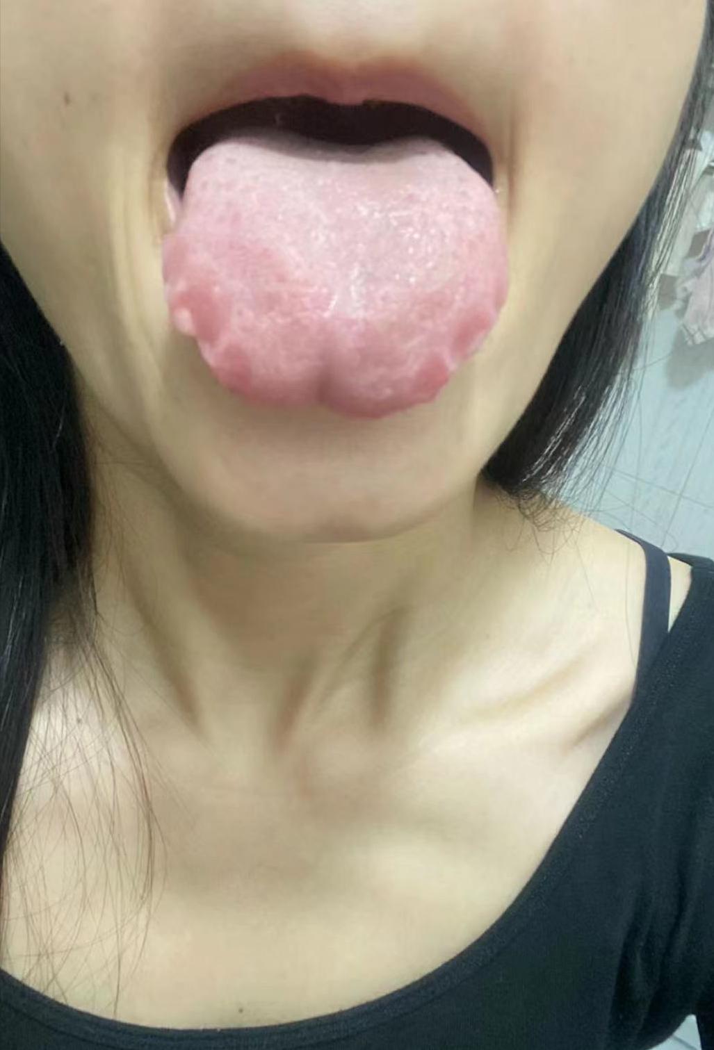 25岁的小美女，看到她舌头第一眼时，感觉她压力好大，烦躁不安！一点点小事，就在心