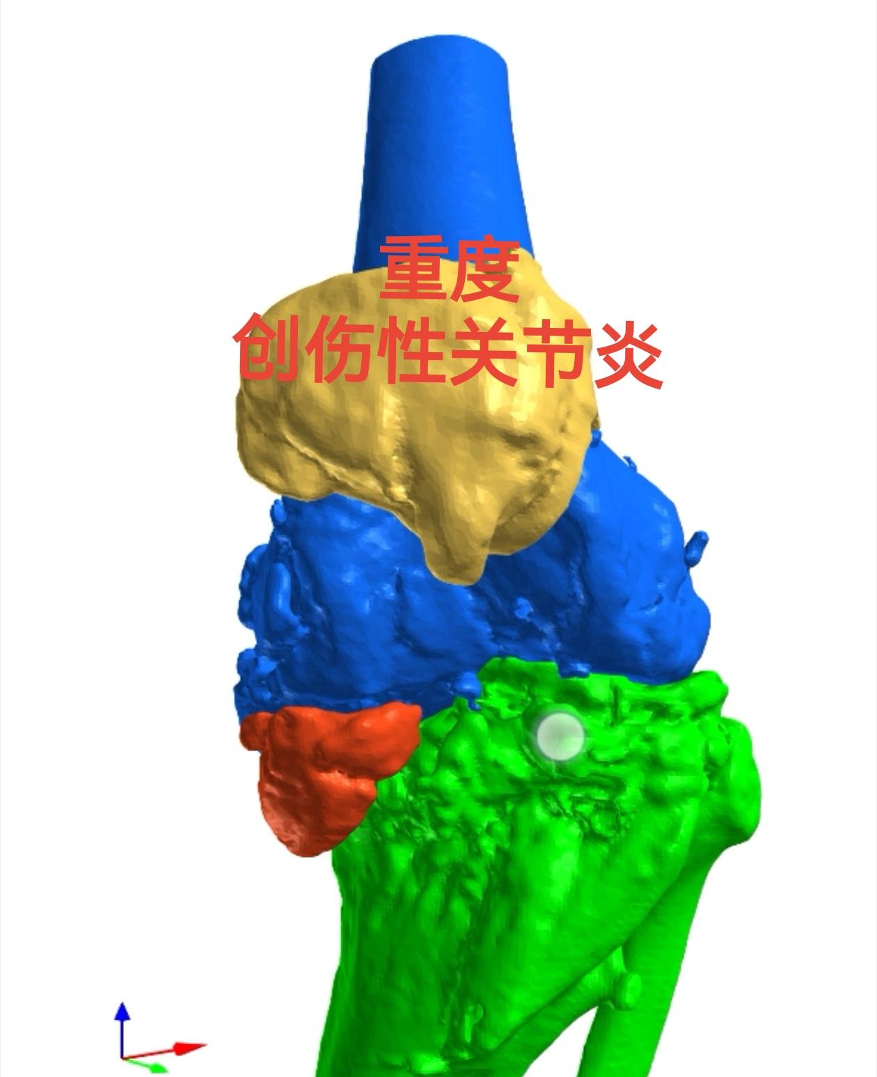 创伤性关节炎，膝关节置换。19岁胫骨平台骨折畸形愈合，未处理，现52岁...