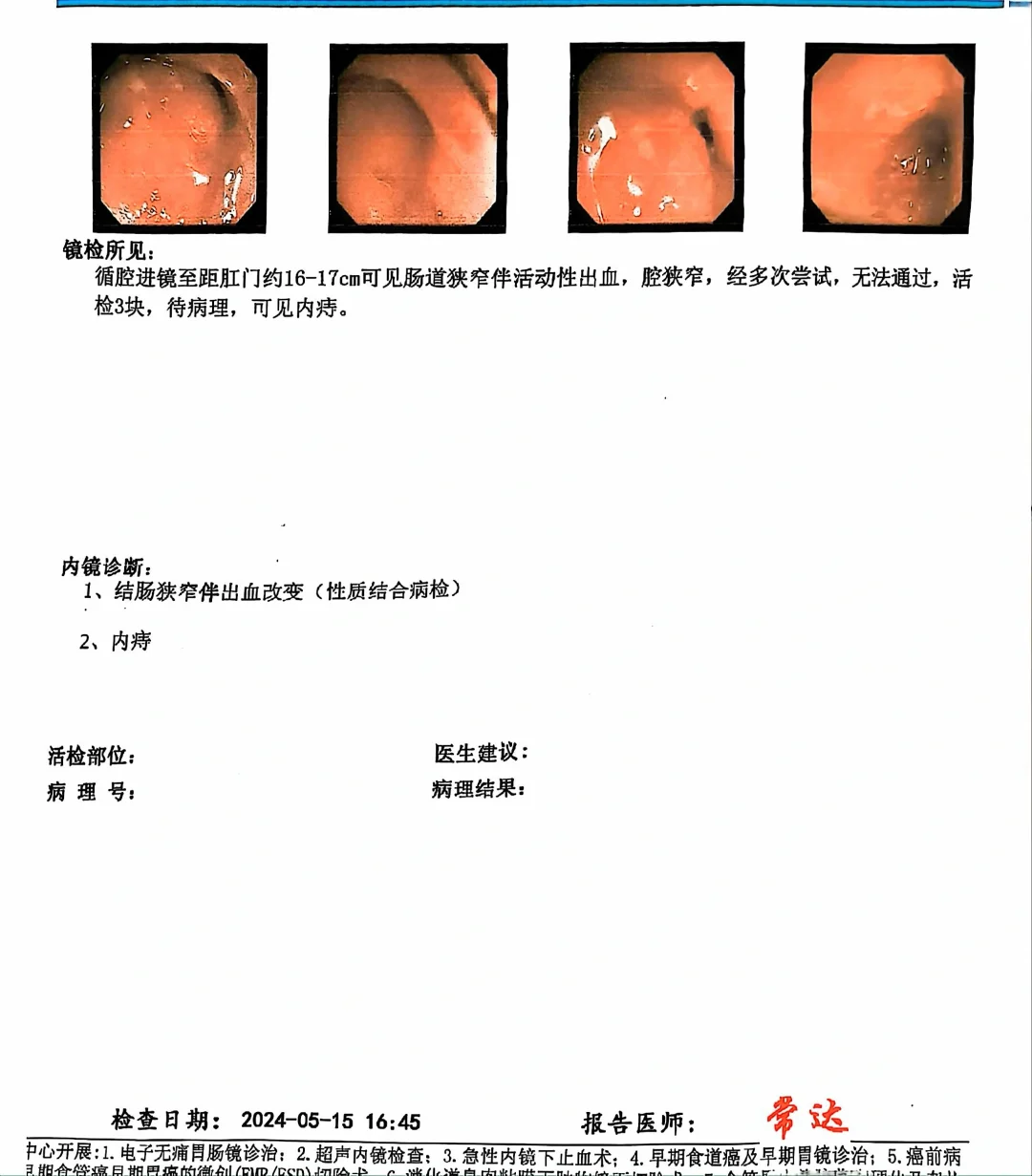 炎症性肠病长期肠镜不愈合是会癌变的！！