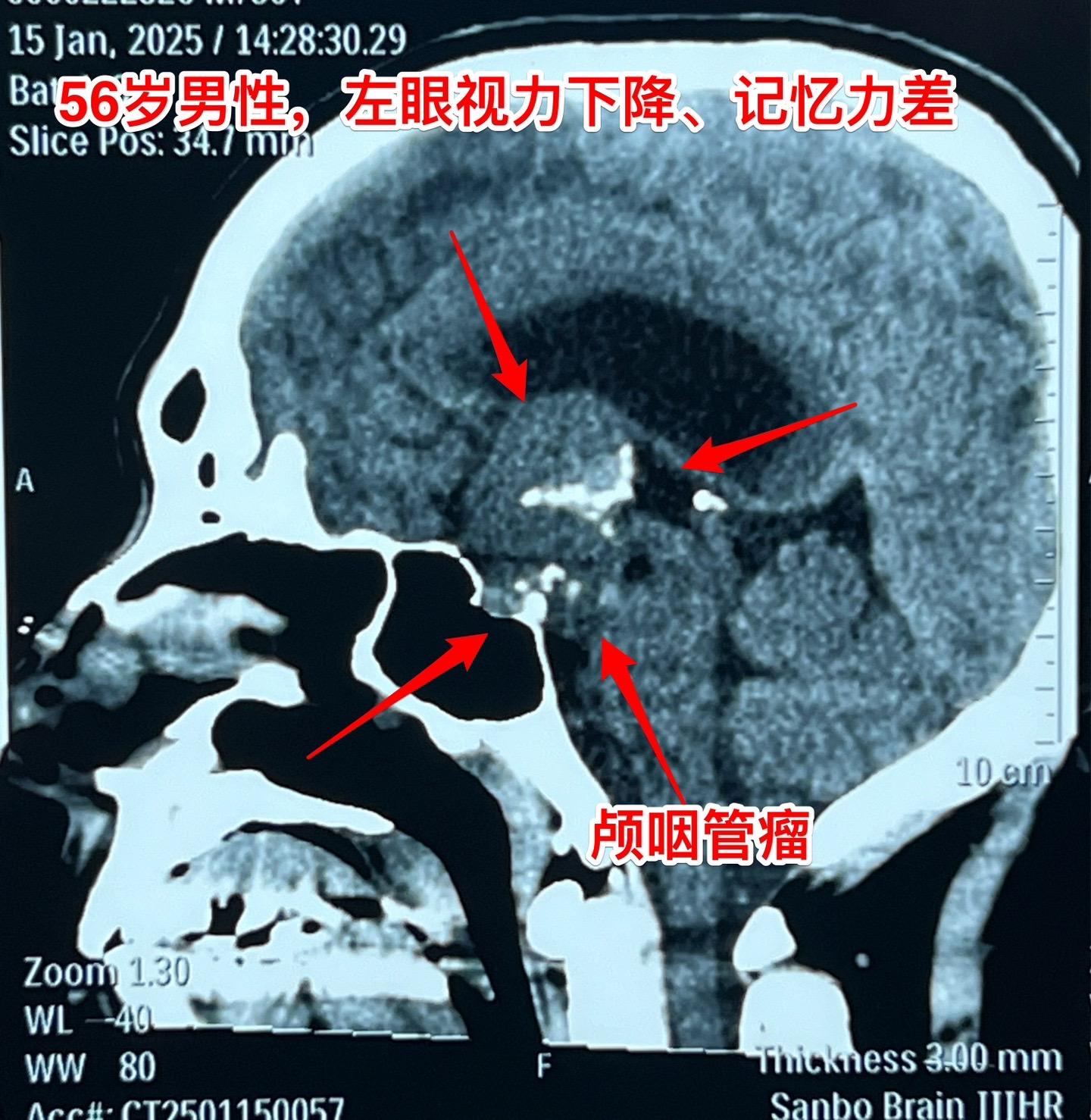 一天两个颅咽管瘤手术，凌晨两点才到家 科里年轻医生说还在关颅。 第一个...
