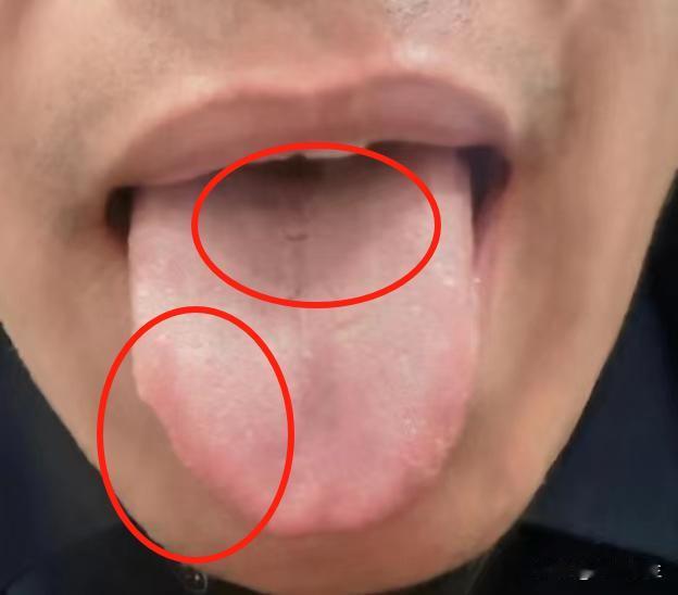 朋友，肾都虚成这样了，怎么还在泻火呢？你这舌苔不是因为火的问题

主诉：消化不好