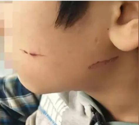 学校霸凌太恐怖了，看这孩子的脸被烫的，这是泸州南滩中学的一名学生被3名同学施暴，