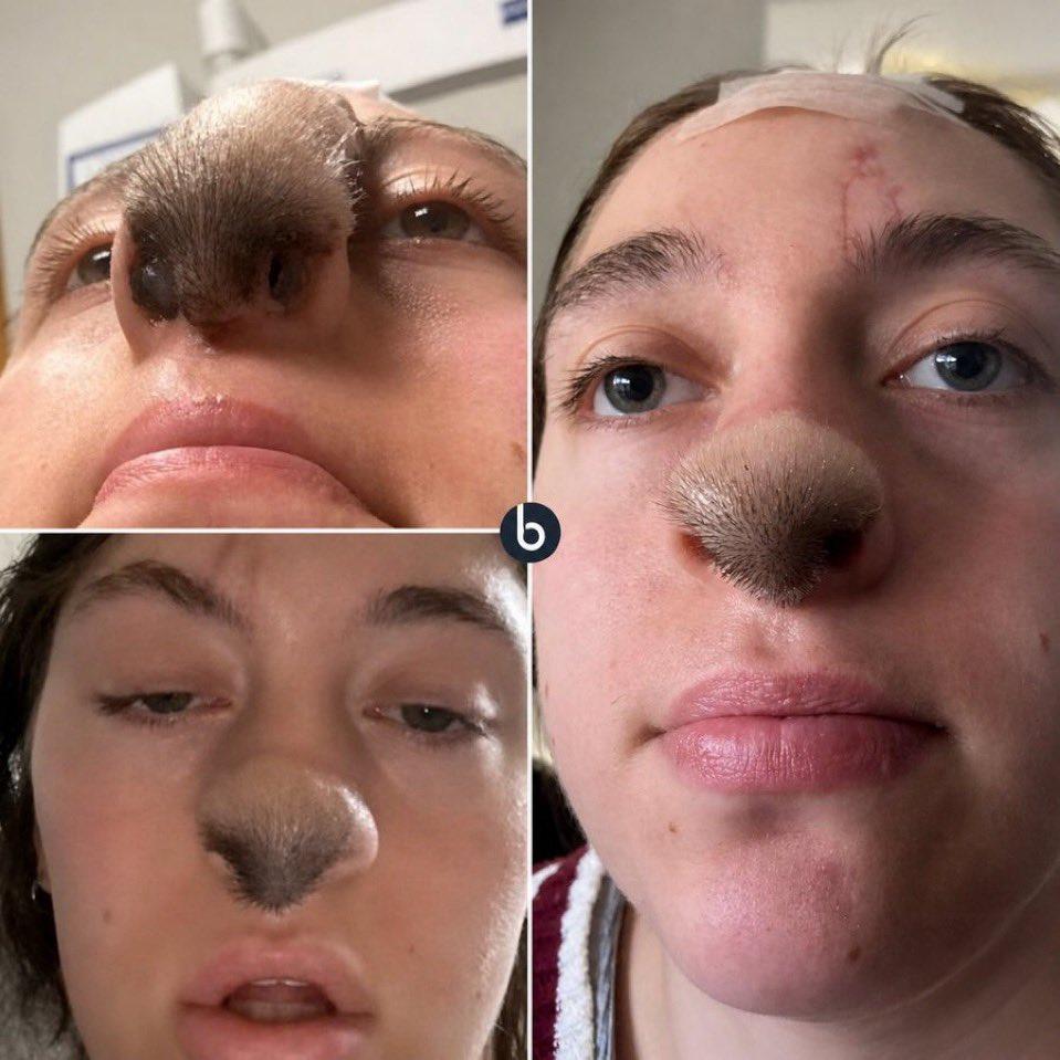 美国女生Trinity Liles被父亲饲养的比特犬混血犬突然袭击，鼻尖部分被严