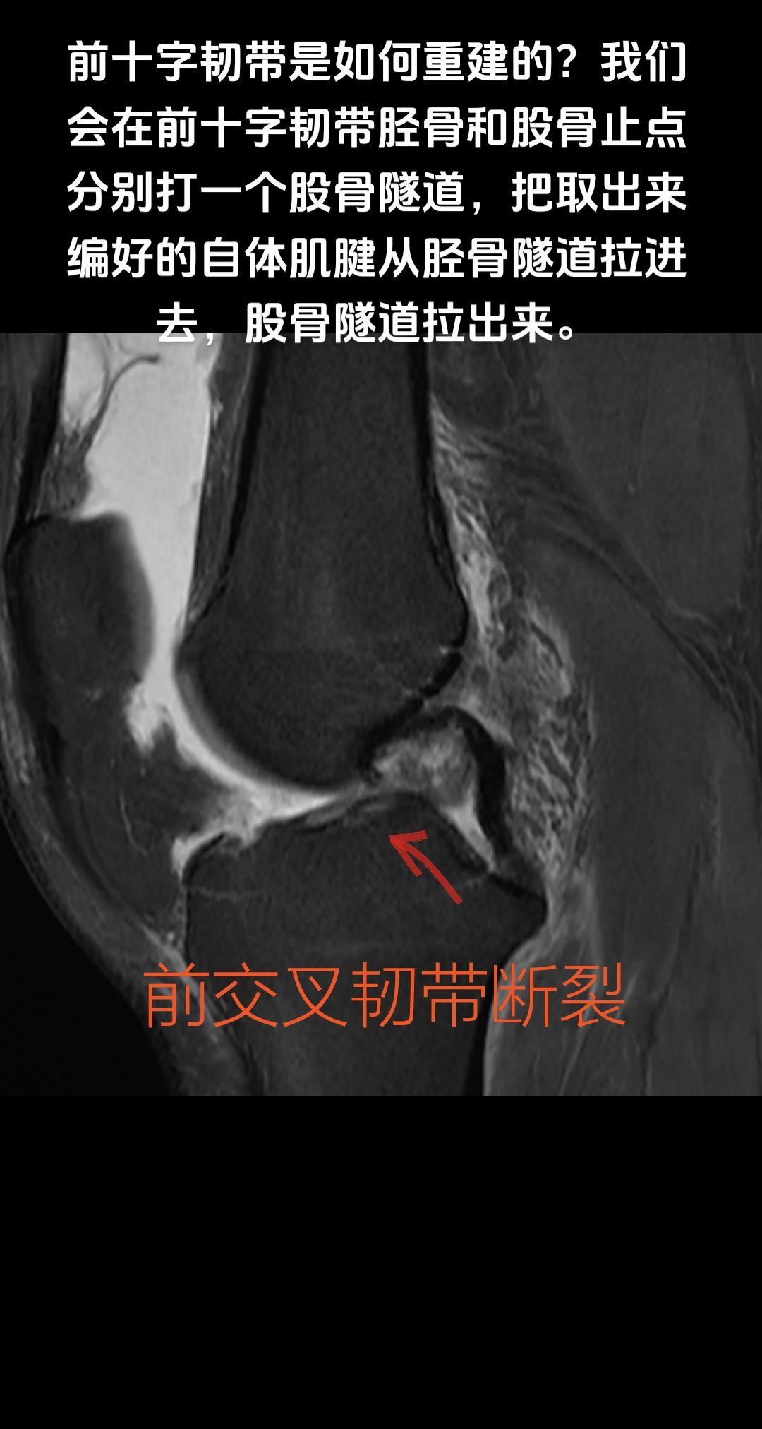 膝关节前十字韧带是如何重建的？重建