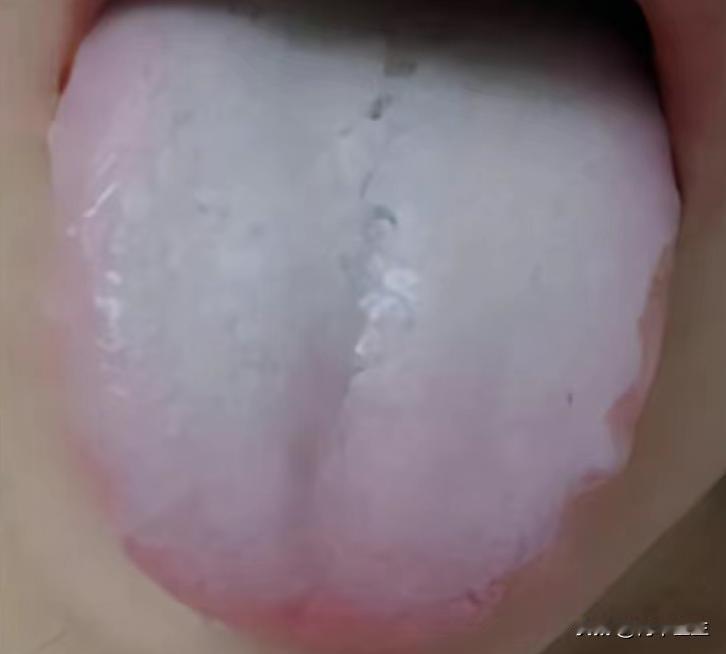 今日舌象总结：

（一）脾阳虚衰， 阴寒内生
症状：舌质淡白，舌体胖大，有齿痕，