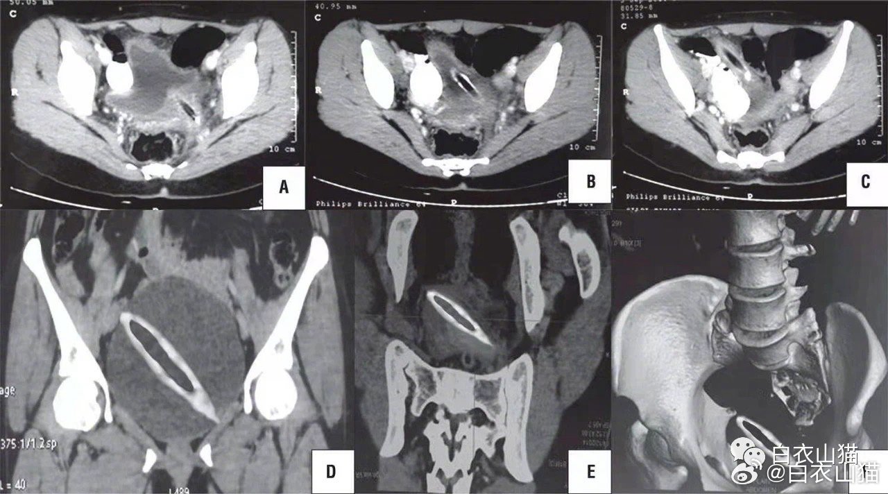 她阴道反复流脓恶臭一月就诊，医生探明病因后，老公当场发狂……小兰26岁，结婚两年