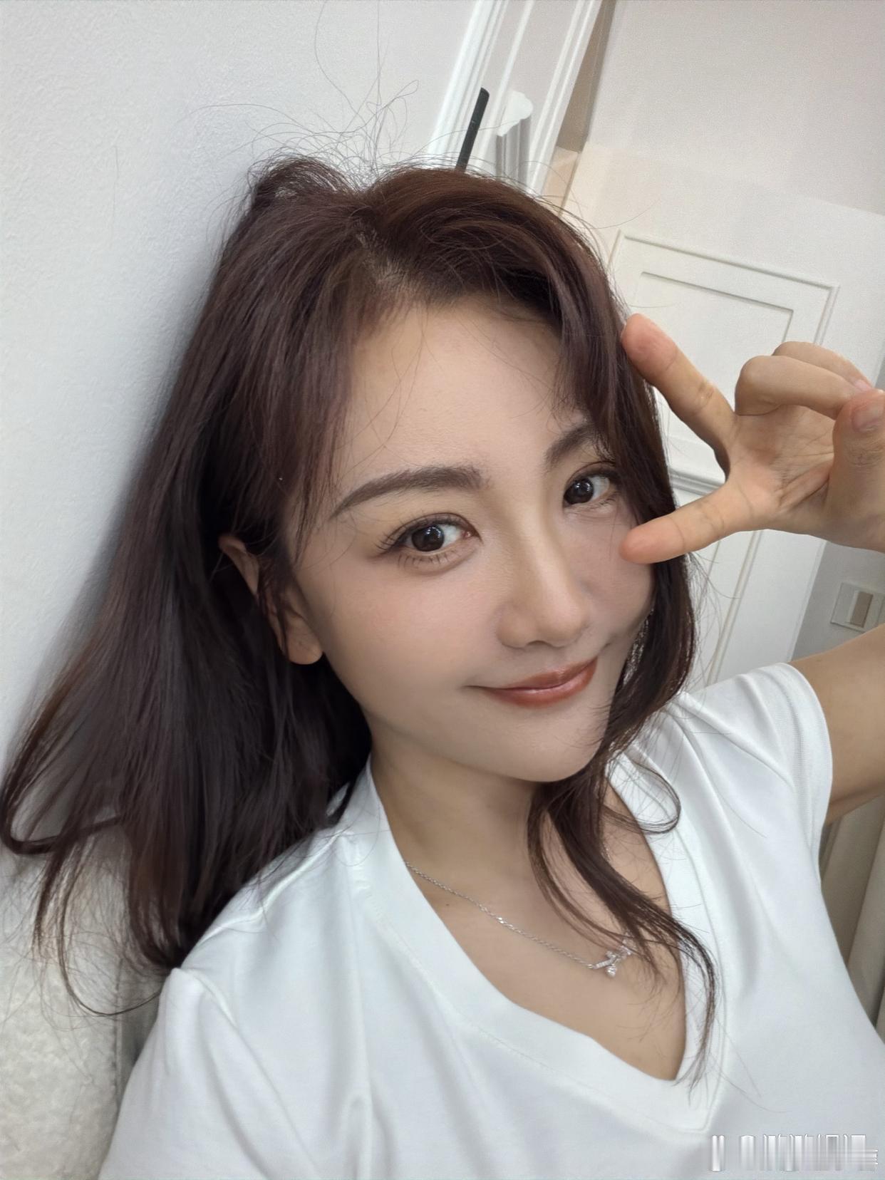 杨蓉面部烫伤恢复近照杨蓉面部烫伤恢复近照，感觉恢复得很好啊，烫伤疤痕基本上看不出