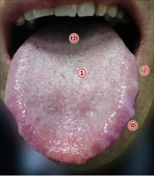 肝郁 + 脾虚 + 肾虚，这种舌头！吃 10 斤参苓白术、桂附地黄丸也白搭，我只