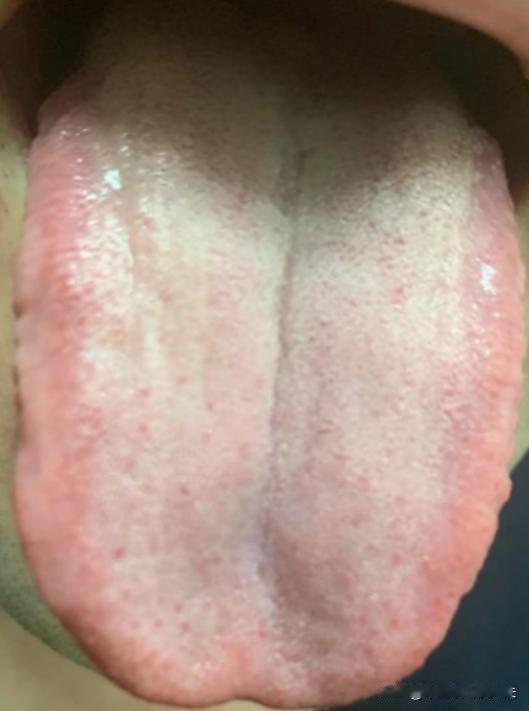 尖凹陷，舌根鼓胀？教你一招通中焦，逼出痰湿一身轻松
平时在家三天一大吵，两天一小