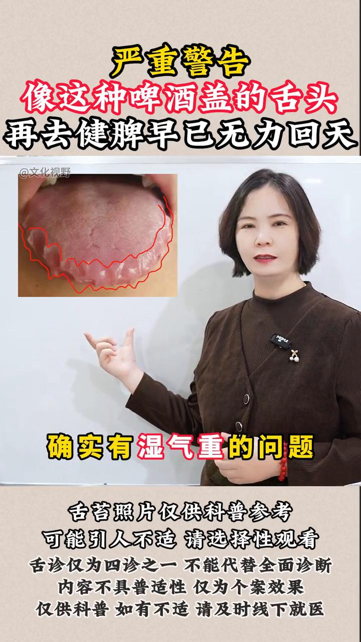 严重警告：像这种啤酒盖的舌头再去健脾早已无力回天。

像这种啤酒盖的舌象如果再去