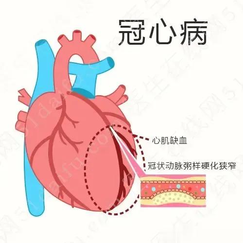 简单易懂，10条冠心病1. 冠心病是指冠状动脉发生狭窄或堵塞，导致心脏供血不足的