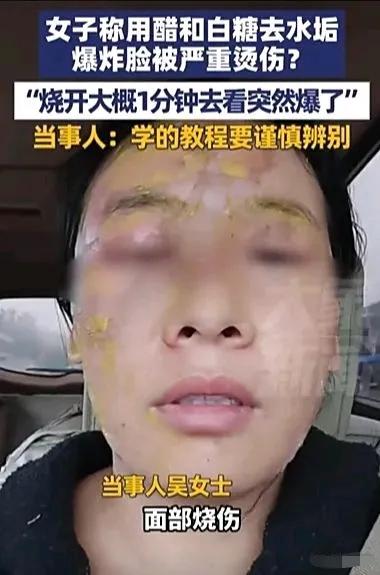 太吓人了！邯郸42岁吴女士在家模仿网红妙招除水垢，脸被烫得面目全非！就因往保温壶