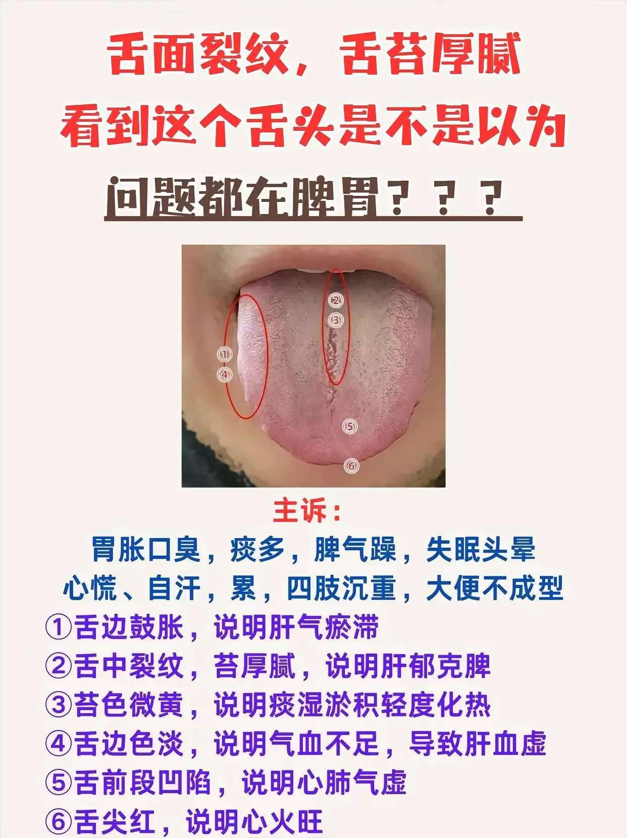 舌面裂纹，舌苔厚腻，看到这个舌头是不是以为问题都在脾胃???

主诉:
胃胀口臭