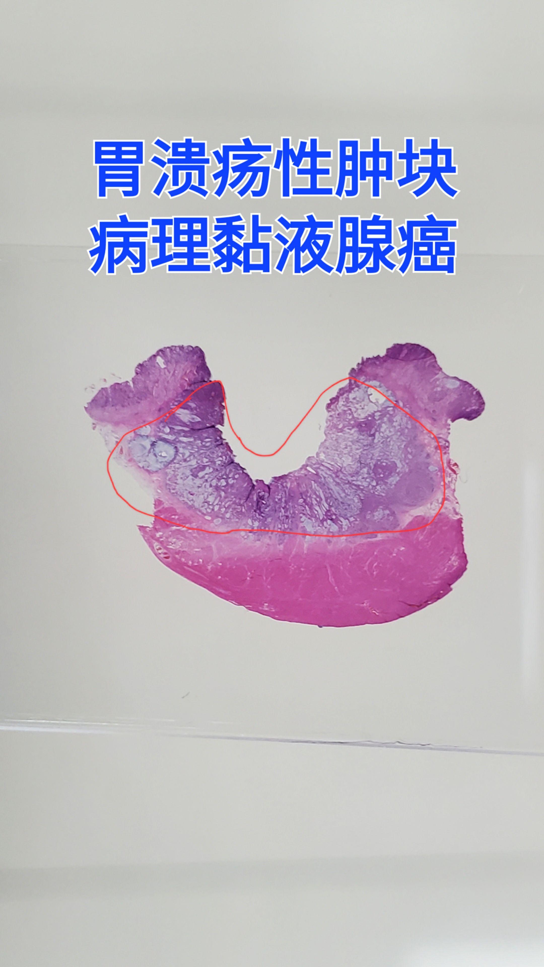 胃癌 黏液腺癌