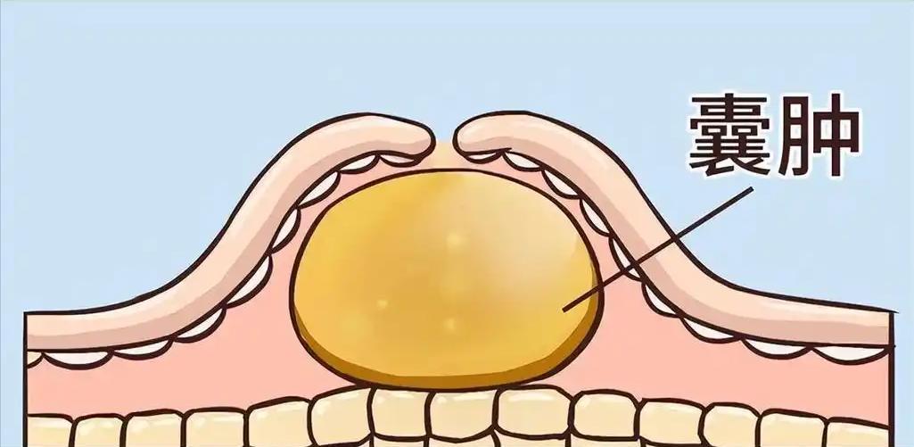 医生：大多数囊肿不用处理，但若出现在这2个地方，需要提高警惕

囊肿，这个词可能