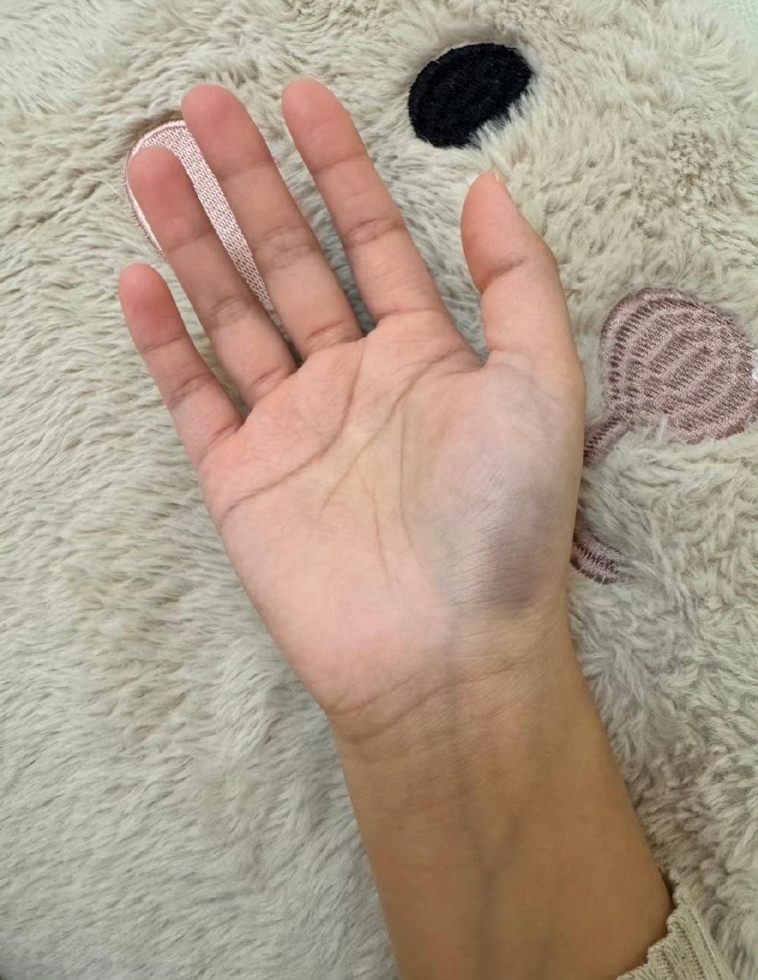 这样的手属于饮食不洁、寒气入心。容易造成血瘀、月经不调、睡眠质量差、气虚、体有淤
