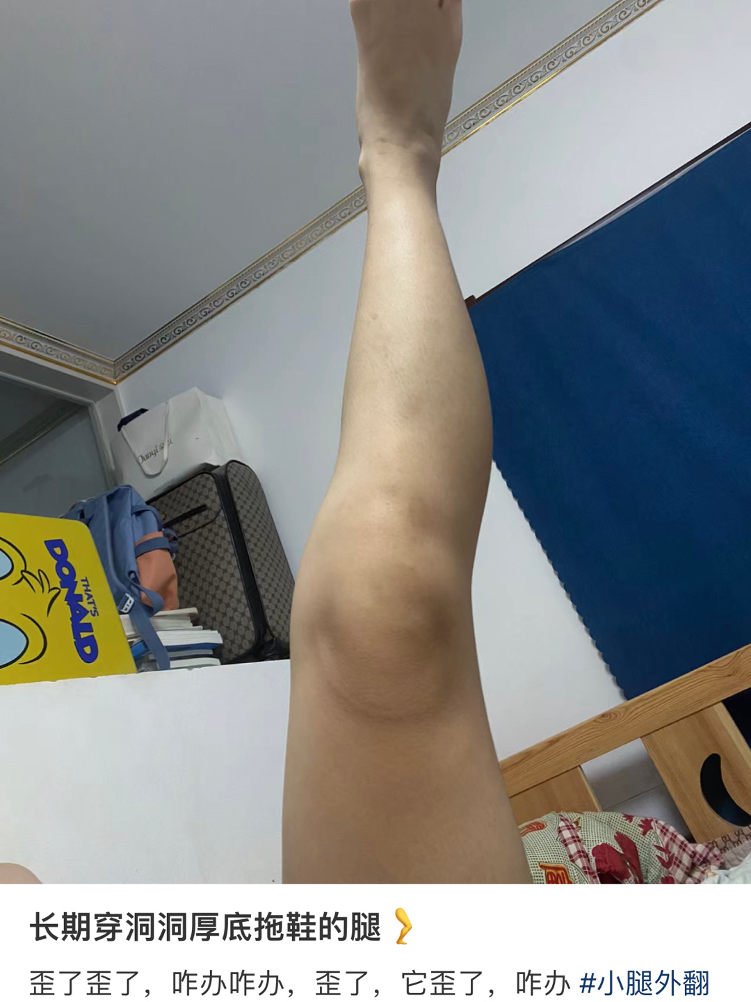 长期穿洞洞鞋后腿歪了 ​​​
