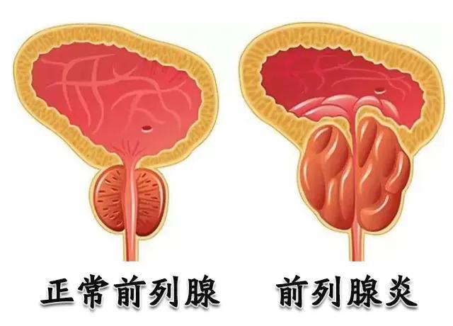 慢性前列腺炎困扰着许多男性朋友，但别担心，今天给大家介绍四种应对方法，总有一个适