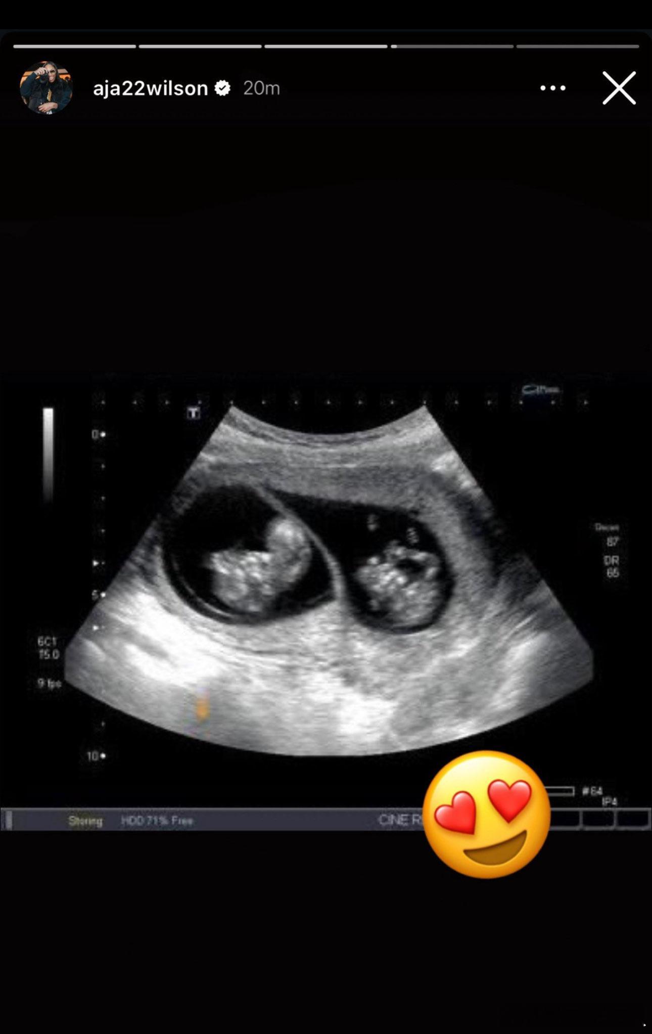 阿德巴约女友怀孕 阿德巴约女友，WNBA巨星阿贾-威尔逊宣布自己怀孕，还是双胞胎