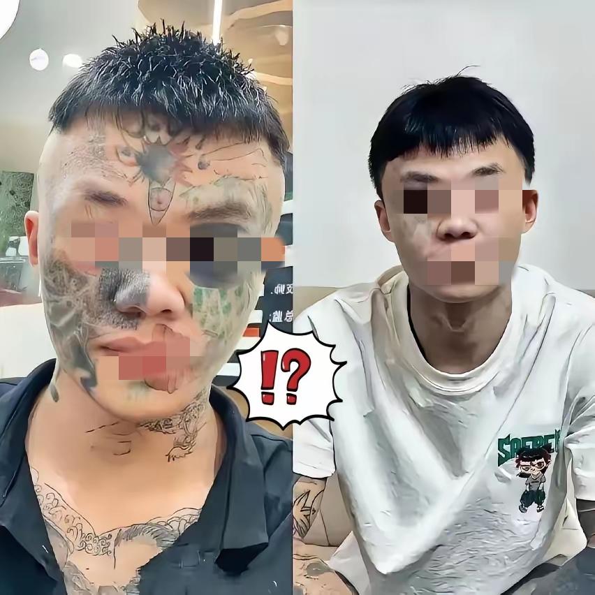 广东男孩夏朝勇的脸上，正用一次次激光灼烧的剧痛，偿还13岁那年的“冲动账单”。为