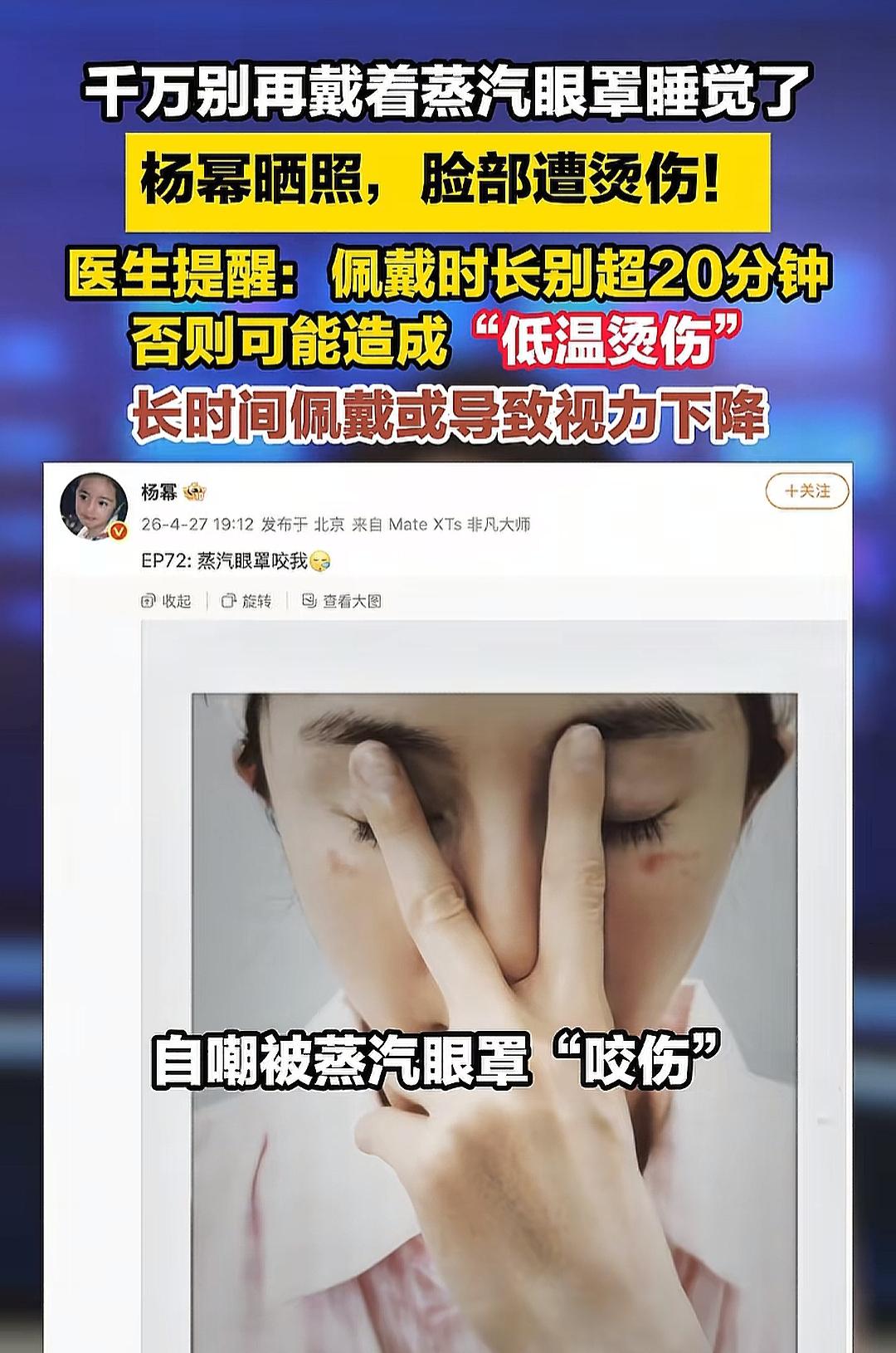 杨幂晒出眼部被烫伤的照片，自嘲“被蒸汽眼罩咬我”，眼周皮肤出现明显的红痕，看得人