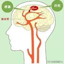 关注：老百姓健康——脑梗
         大家有没有发现自己身边有不少心脑梗患