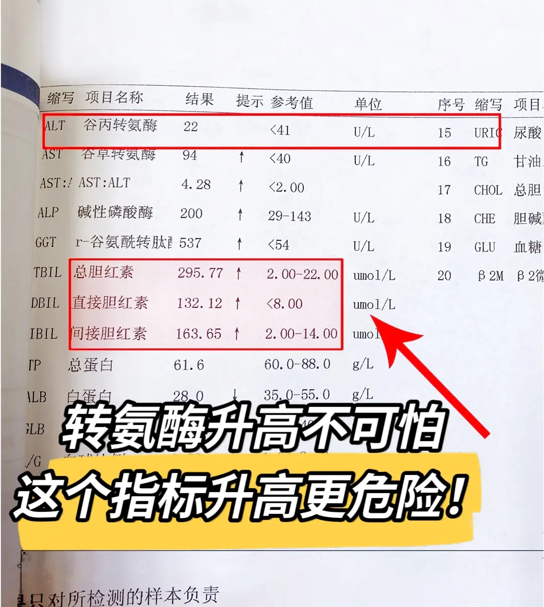 转氨酶高不可怕，这个指标更危险当心肝衰竭。我一个泰安的病号，已经到了肝...