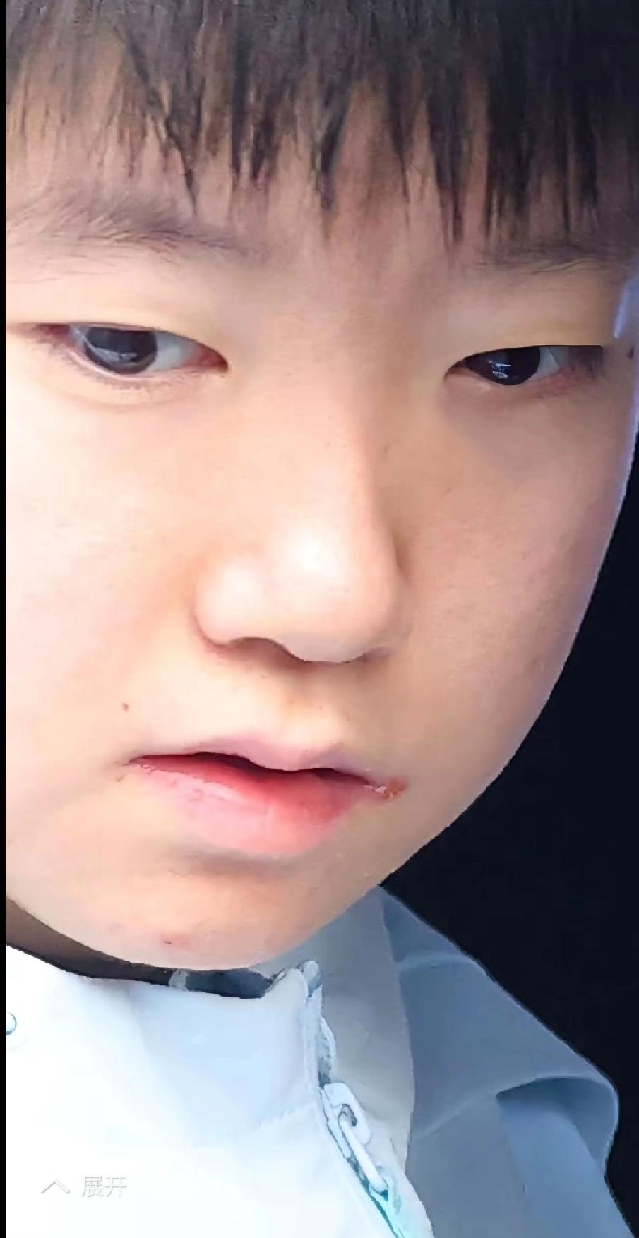 伦敦世乒赛，心疼孙颖莎的嘴角！
 
刷到采访视频，第一眼就注意到莎莎嘴角的小伤口