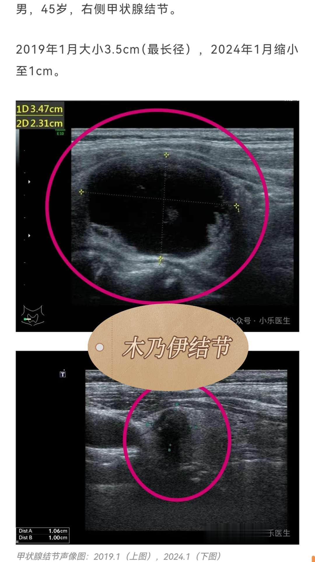 甲状腺“木乃伊”结节。甲状腺结节木乃伊化过程主要涉及囊性或囊性为主、T...