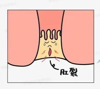 肛裂能够自愈吗？