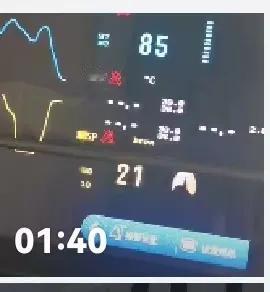 我妻子1分40秒的氧饱和度录像，居然有二次从69到停顿到100到停顿到70的过程