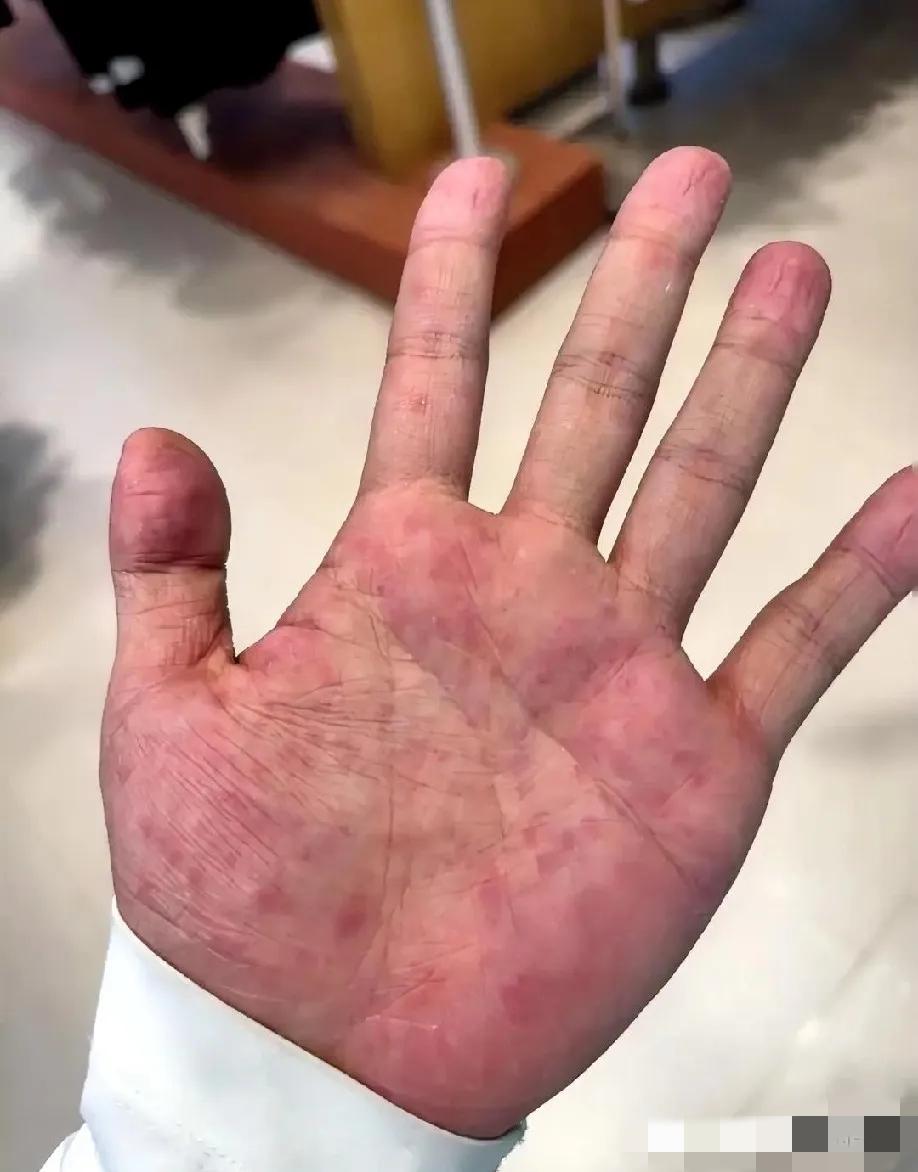 友友们！谁懂啊！手掌心又红又痒，这到底是什么个情况？救我啊……