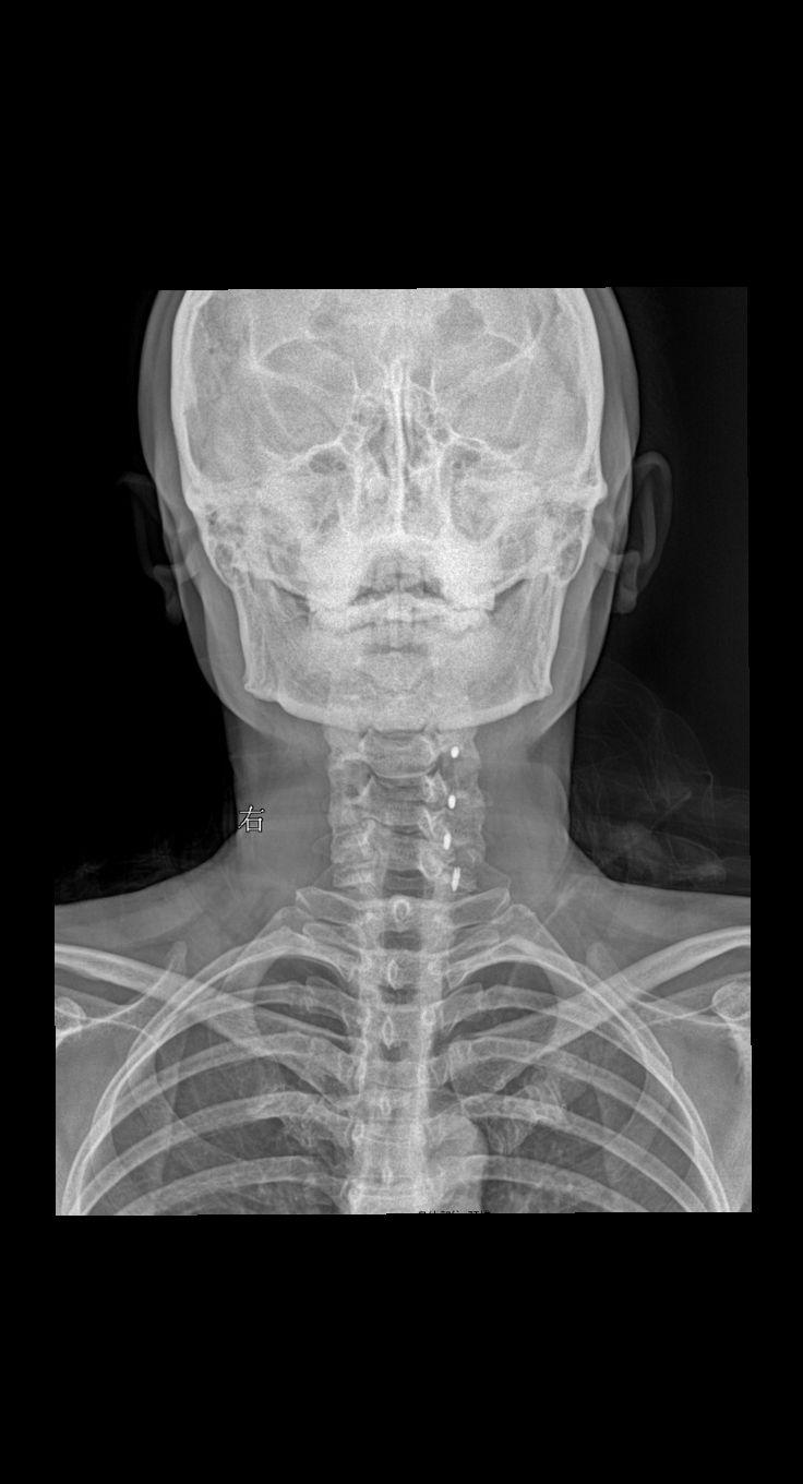 颈椎术后，疼痛就诊 45岁