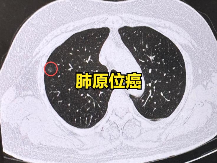 肺结节术后报了原位癌、微浸润癌会复发吗？需要化疗、吃靶向药吗？其实大家完全不用过