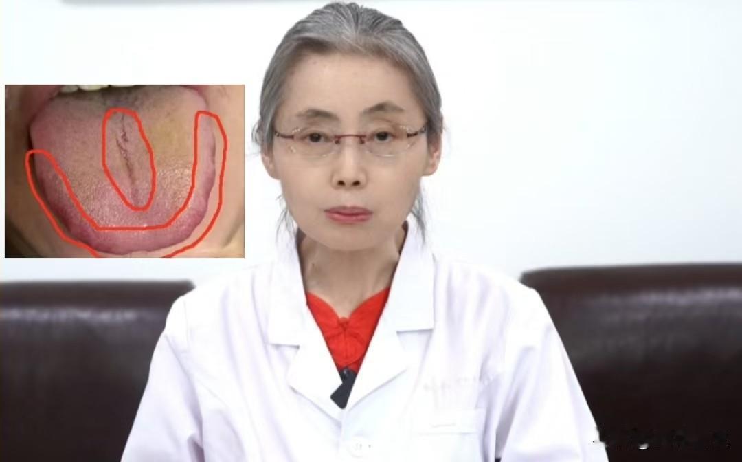 舌苔又白又黄，很多人忽略了阳虚，千万别当成肝胆湿热来治！

患者主诉：阴囊潮湿，