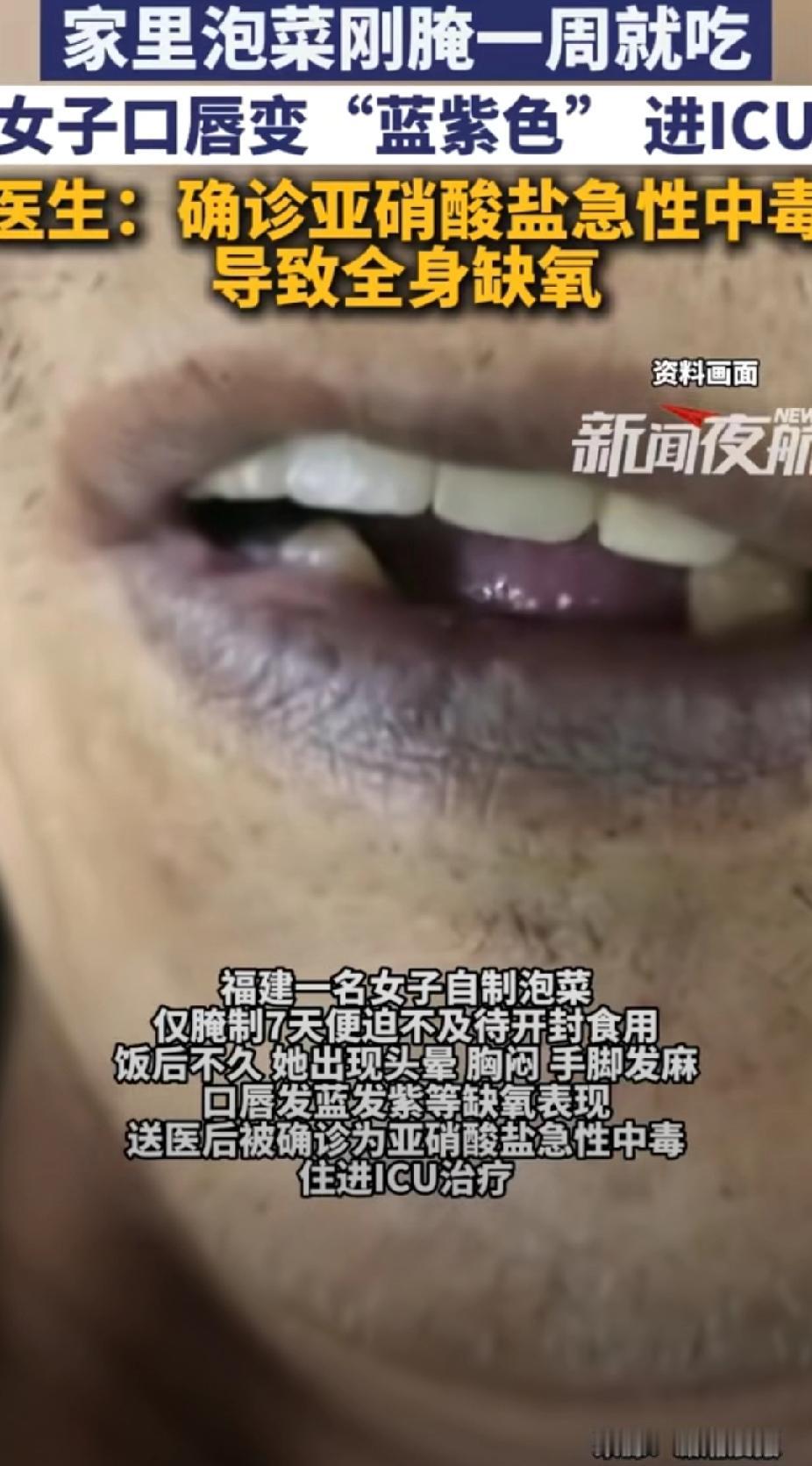 “悲剧还是发生了！”近日，福建，一女子食用腌制一周的泡菜后。没想到，亚硝酸盐急性