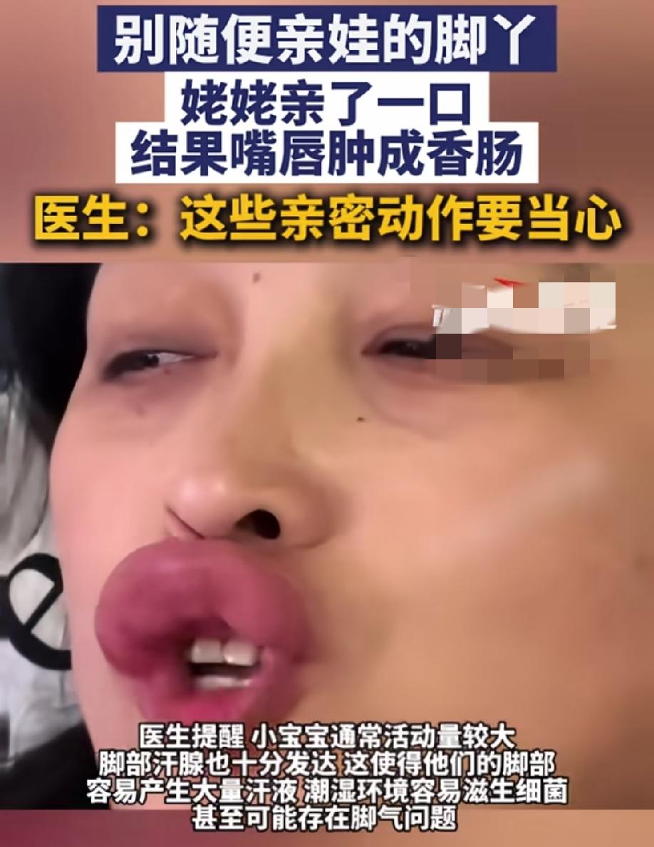 笑不活了！
5月19日，河北一姥姥不听劝，只是亲了一下外孙的脚丫，结果嘴唇肿成了