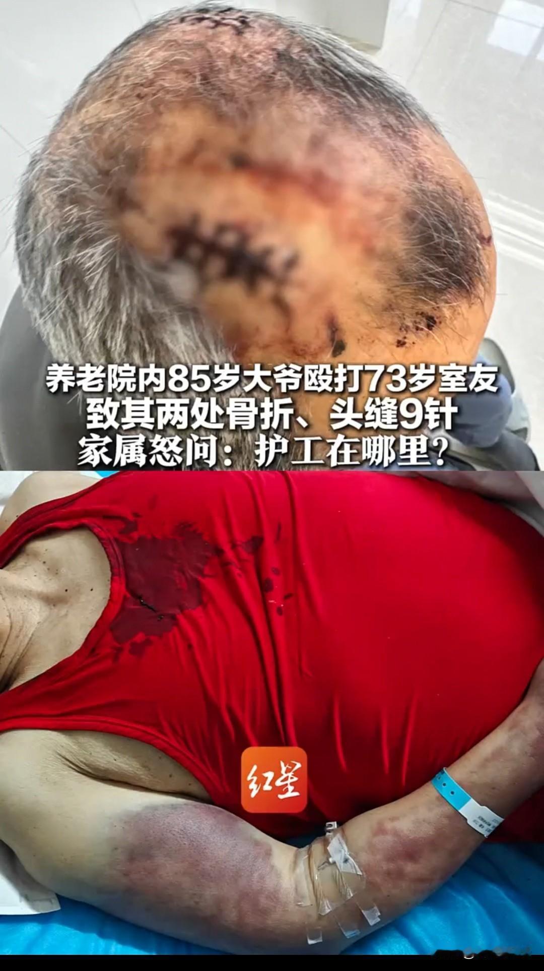 简直令人发指！内蒙古赤峰，一位73岁老人，在收费不菲的养老院里，被同住的85岁老