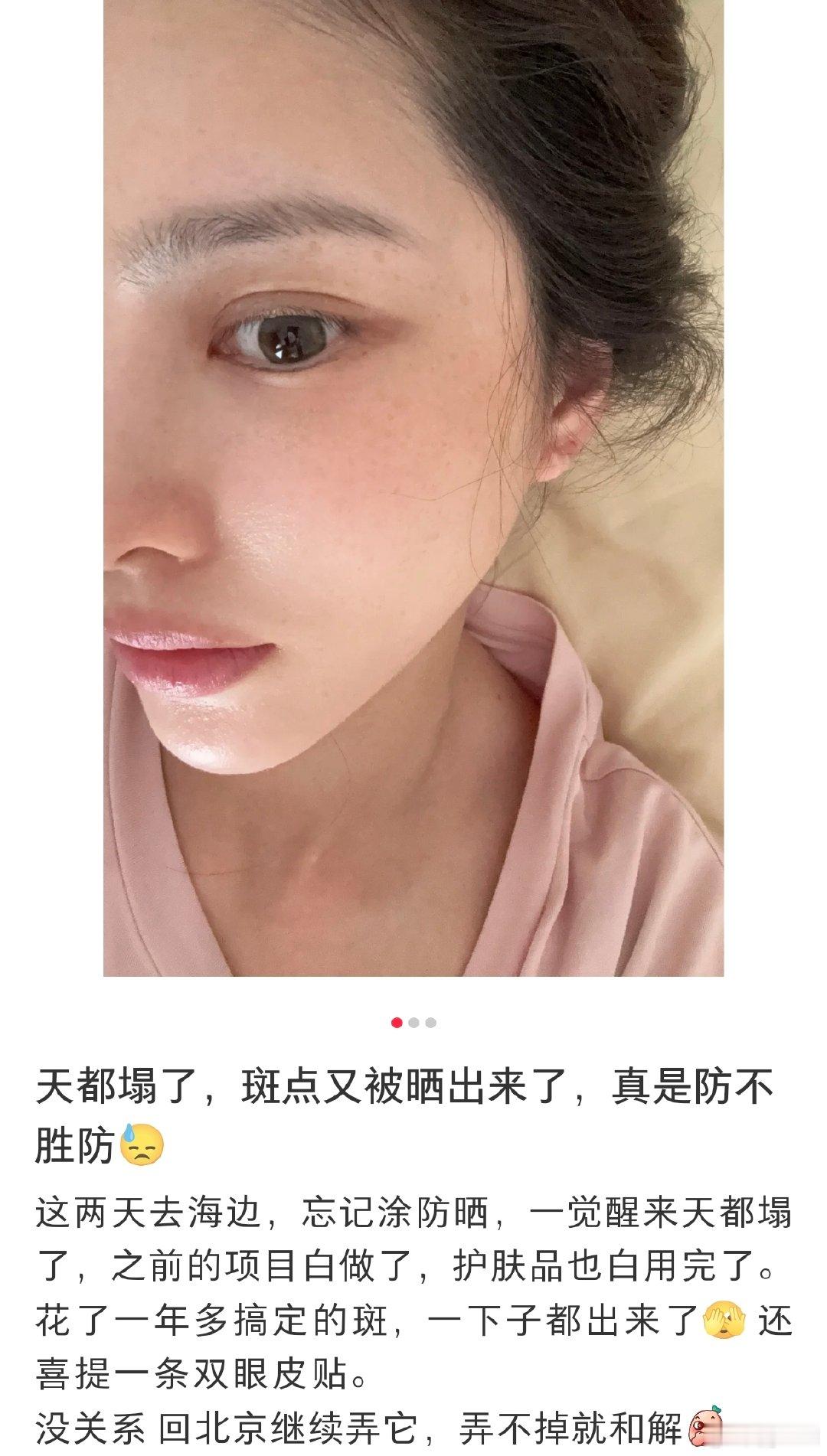王灿旅游晒出雀斑王灿海边忘记涂防晒，雀斑直接 “集体出逃” 啦～不过咱就是说，有