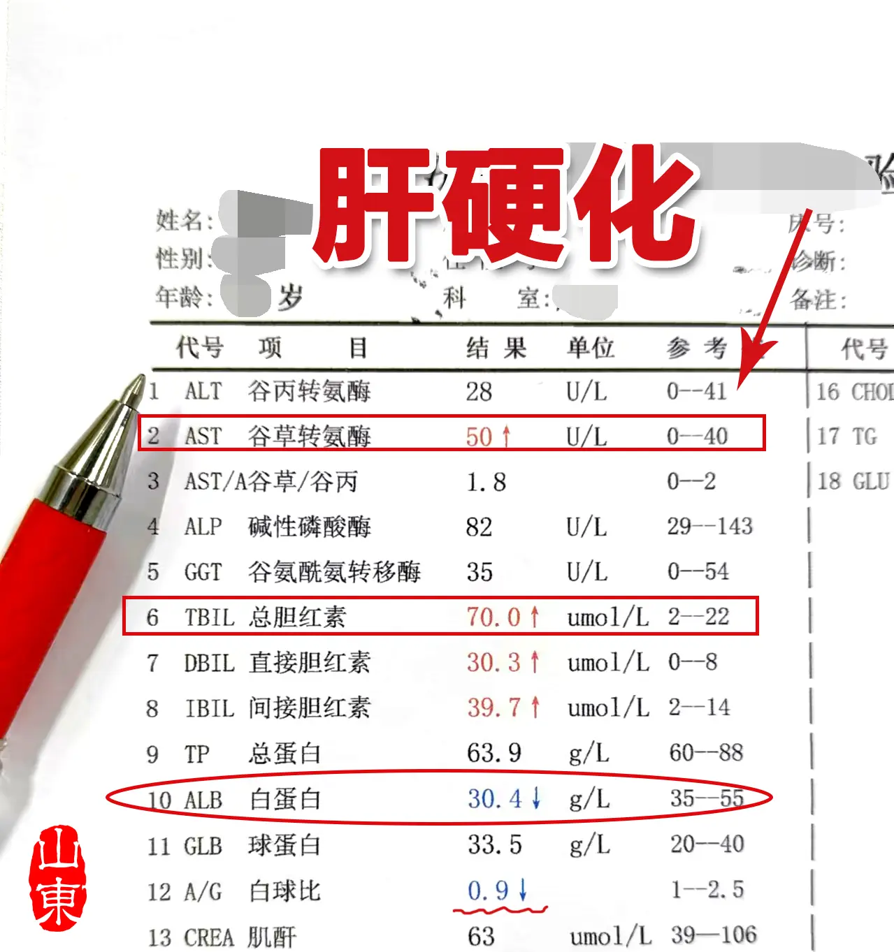 这是一位菏泽患者化验单，谷丙和谷草正常或轻度升高，却肝硬化了。小伙病毒...