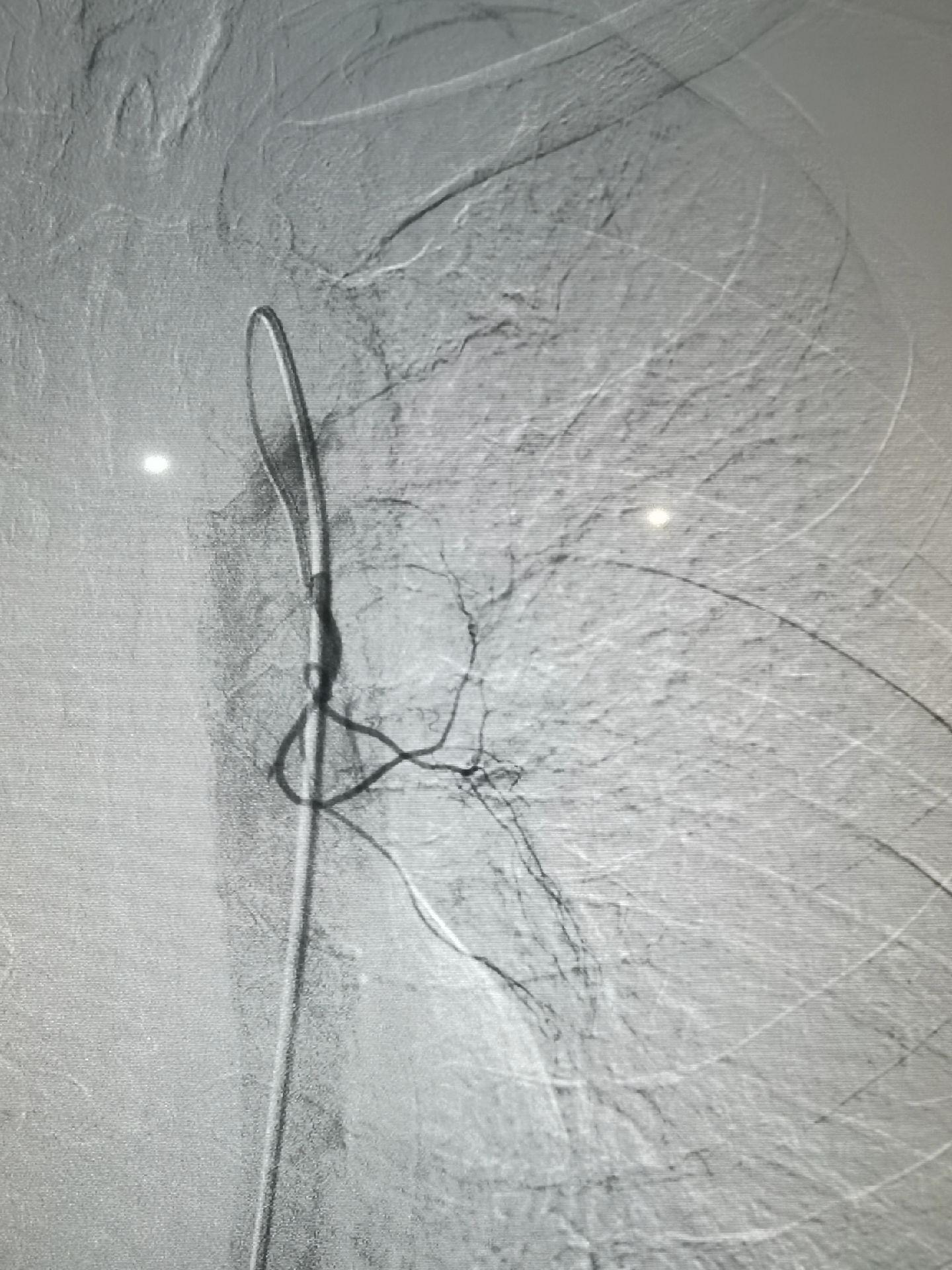 肺癌伴两肺转移，癌性淋巴管转移，体肺动脉化疗，支气管动脉联合肺动脉置管化疗。