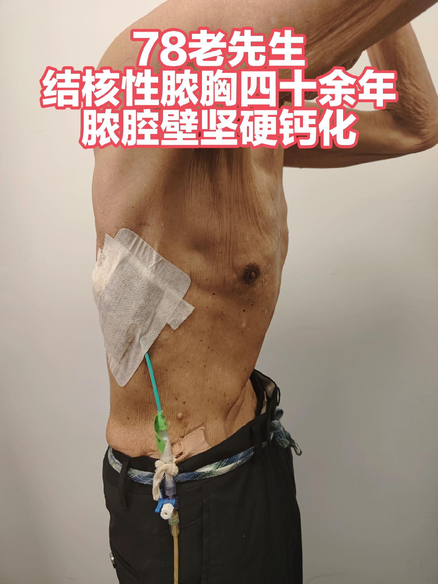 徐州病友，高龄老先生，结核脓胸四十余年，带管引流近半年，体重仅有80斤...