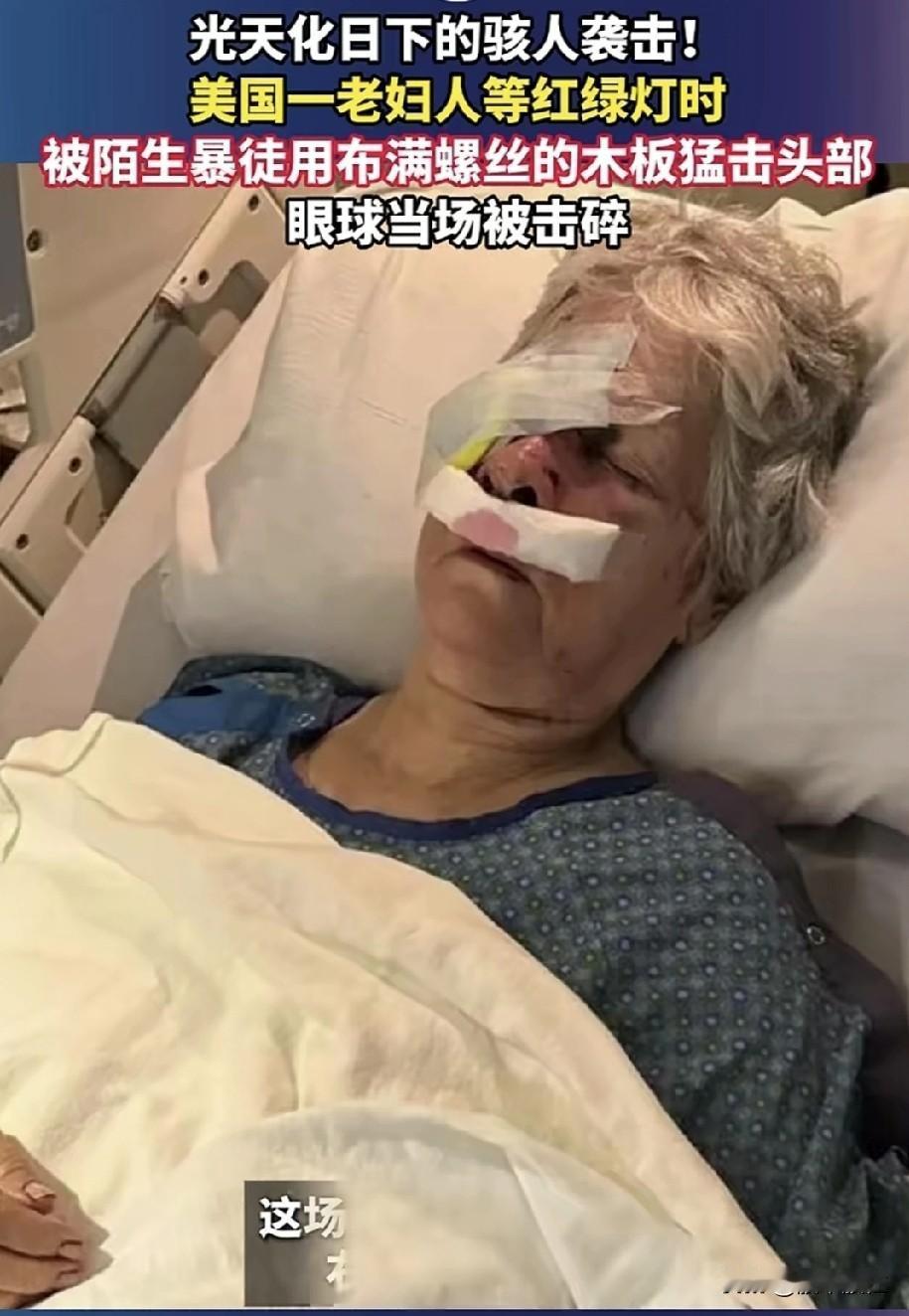 太可怕了！
眼球当场被击碎！
大白天老妇人等红绿灯时，
被陌生暴徒用布满螺丝的木