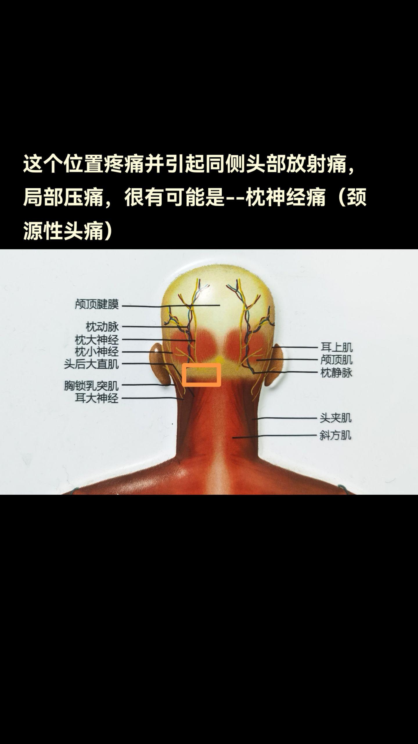 这个位置疼痛并引起同侧头部放射痛，局部压痛，很有可能是--枕神经痛（颈源性头痛）