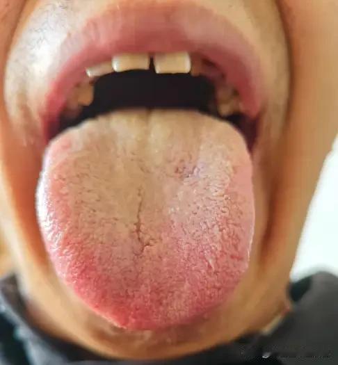 肝郁脾虚夹湿热：调理忌直清直补，顺序错则越调越虚
 
当肝郁、脾虚、湿热三者缠在