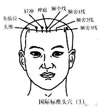 头针穴名国际标准化方案

标准头穴线均位于头皮部位，按颅骨的解剖名称额区、顶区、