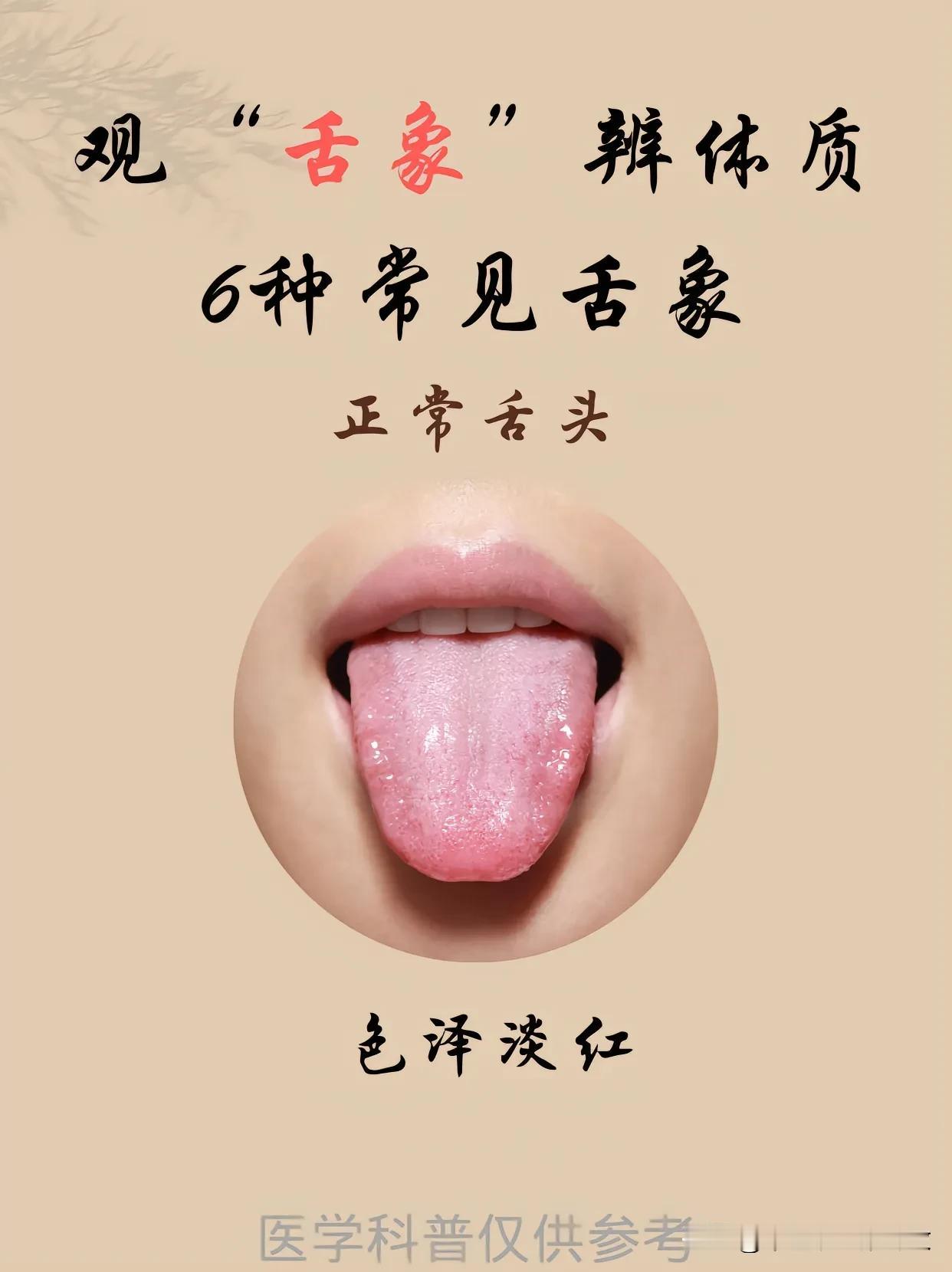 观舌象，辨体质，脾虚，内热，寒湿，痰重
六种常见舌象分享给你！[玫瑰]
#脾胃#